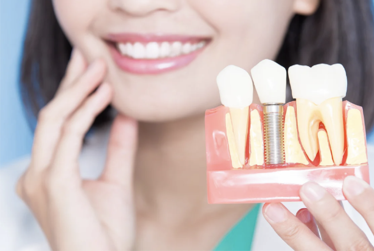 Dental Implants