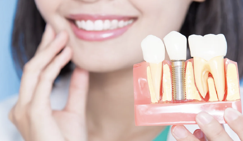 Woman Smiling and holding a model of a Dental Implant