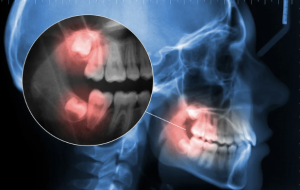 Wisdom Teeth: Everything You Need To Know